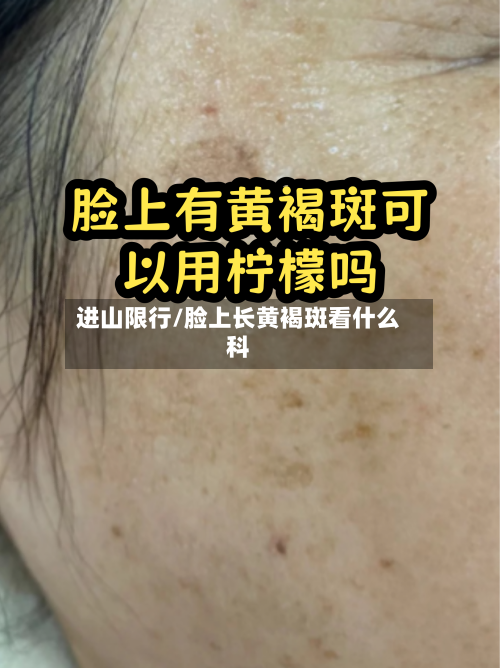 进山限行/脸上长黄褐斑看什么科-第2张图片